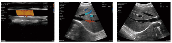 Double probe ultrasound PU80